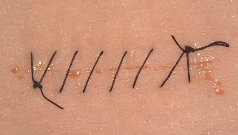 Sutures