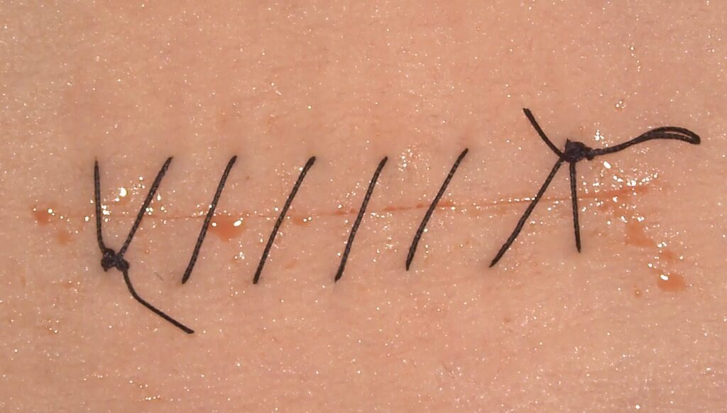 Understanding Sutures: Types, Uses, and Proper Wound Closure Techniques